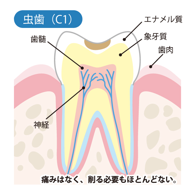 エナメル質の虫歯(C1)