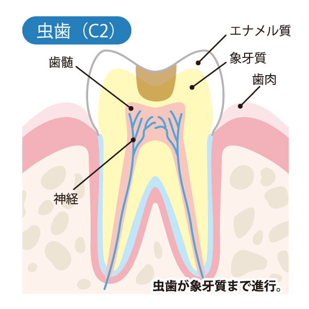 象牙質の虫歯(C2)