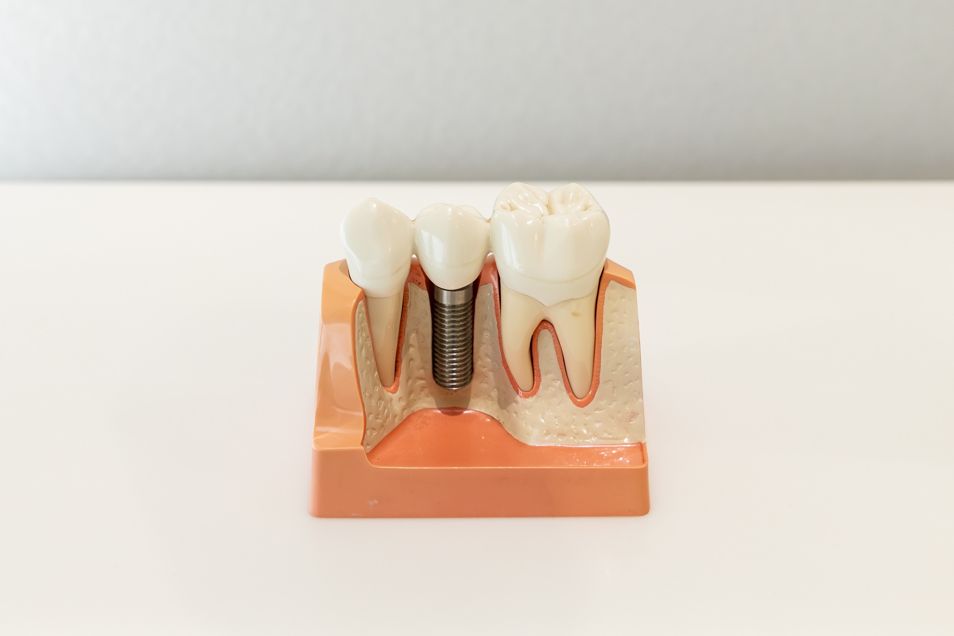 インプラントとは？ブリッジ・入れ歯との違いについて