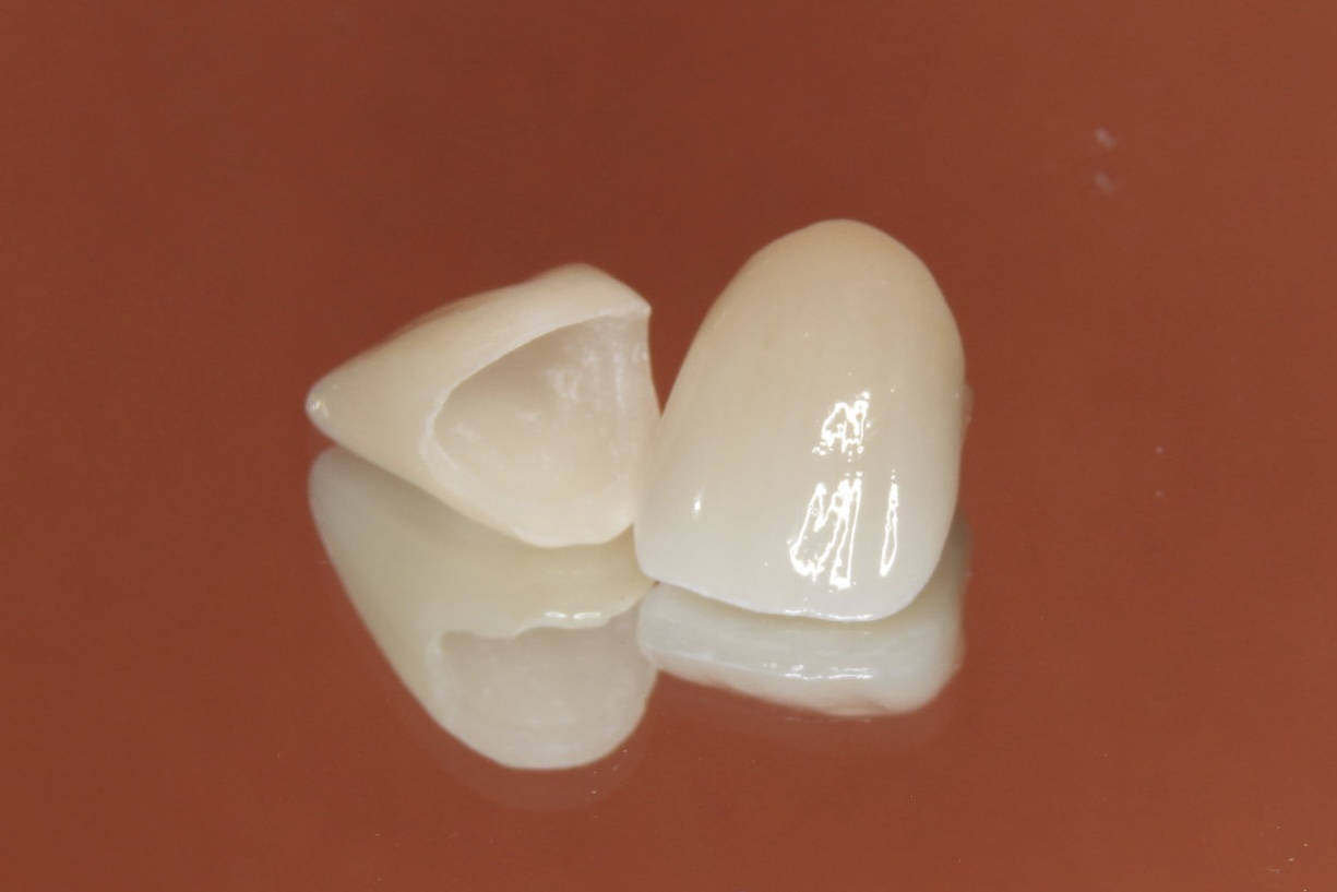 オールセラミック