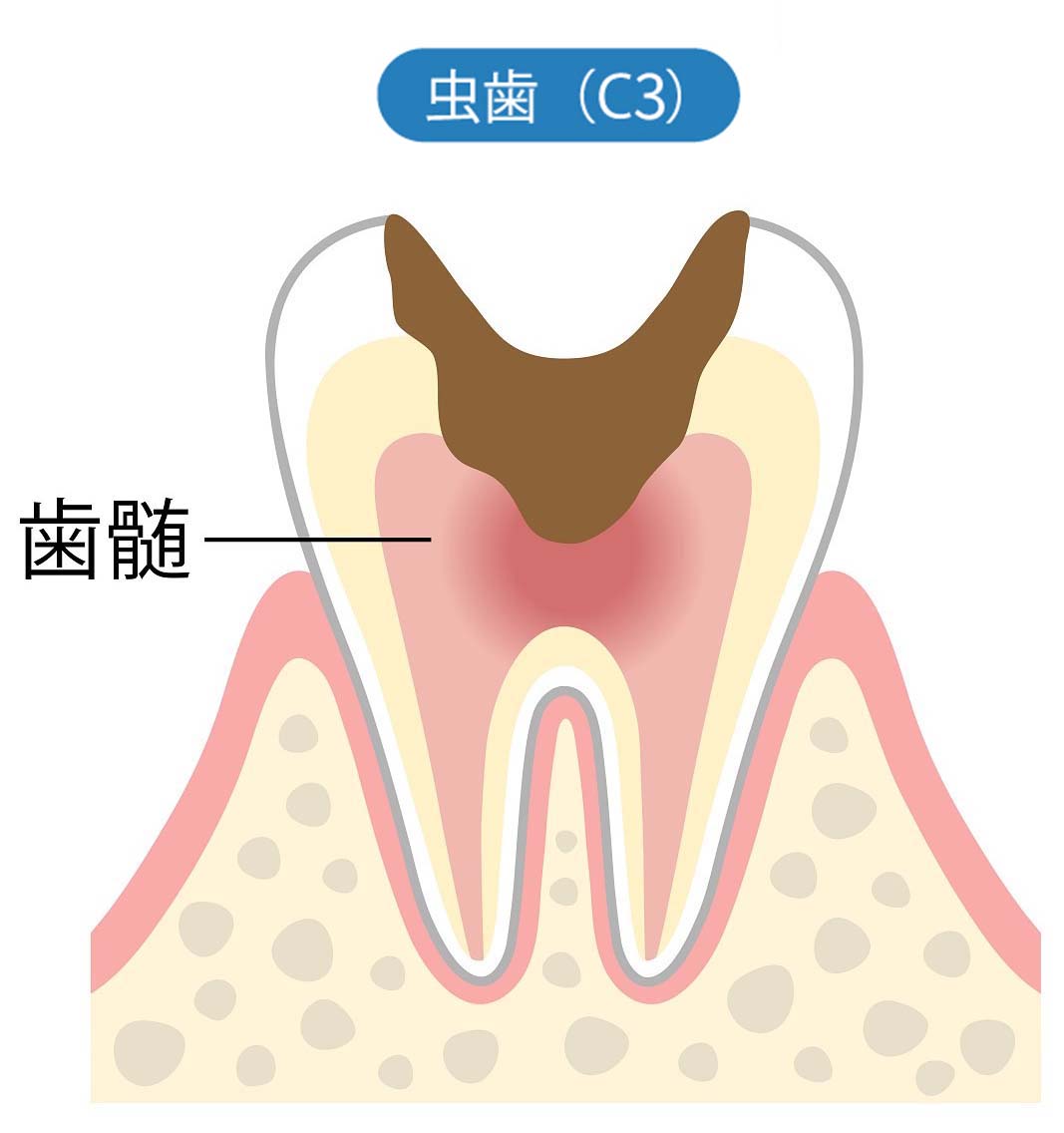 神経に達した虫歯(C3)