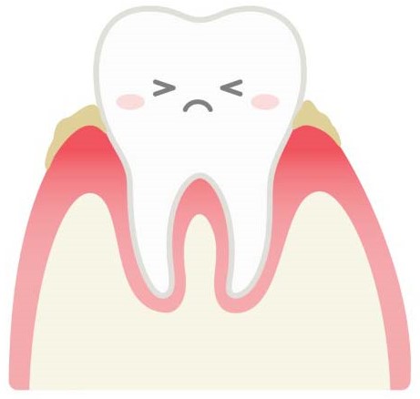 軽度歯周炎