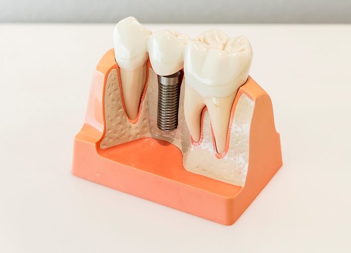 インプラント治療