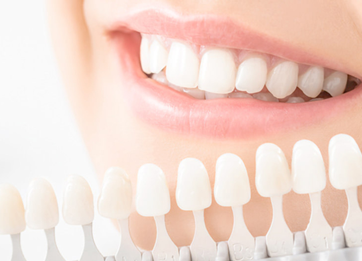 ホワイトニング